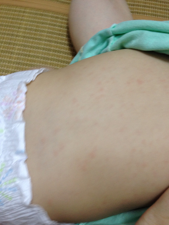 10个月退烧之后全身红点怎么办?幼儿急诊