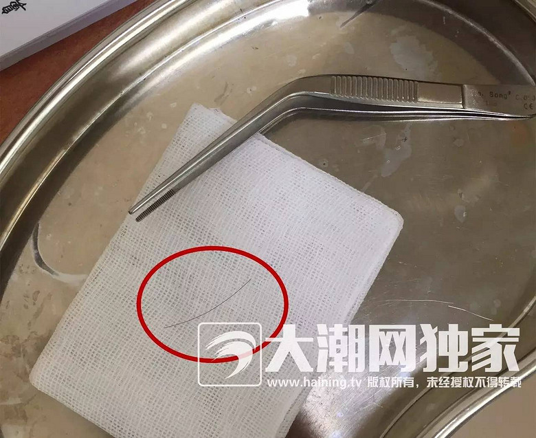 60岁大妈的耳朵一碰就嗡嗡响!医生竟从她耳朵