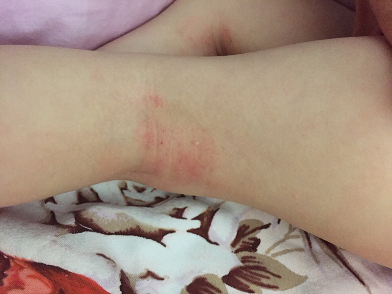 ��֫��������ô�죿