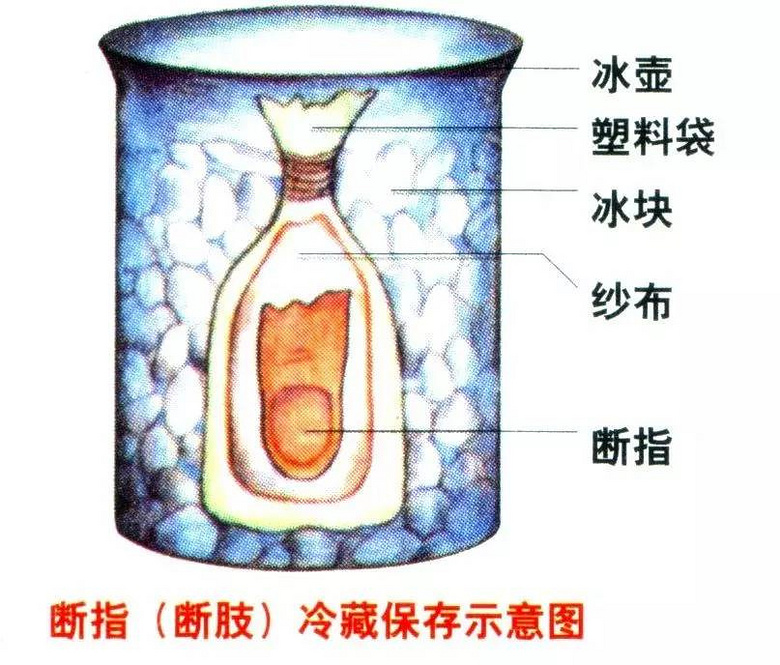 悲剧海宁一对夫妻闹矛盾老婆竟然提刀砍断了老公的手指