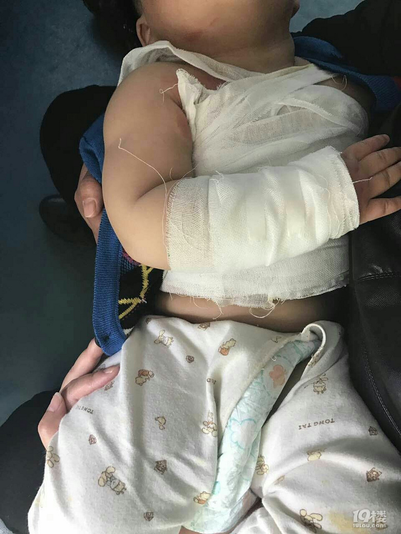 【惨不忍睹!滚烫馄饨泼在小孩身上皮开肉绽】