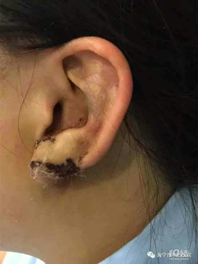 可怕海宁一女子打个耳洞耳垂却肿成4cm大的肉球