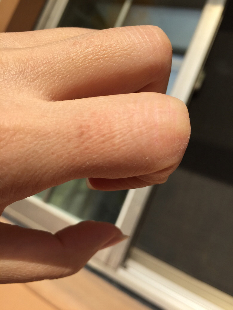 Ƥ���������Ǹ���ȱˮ��