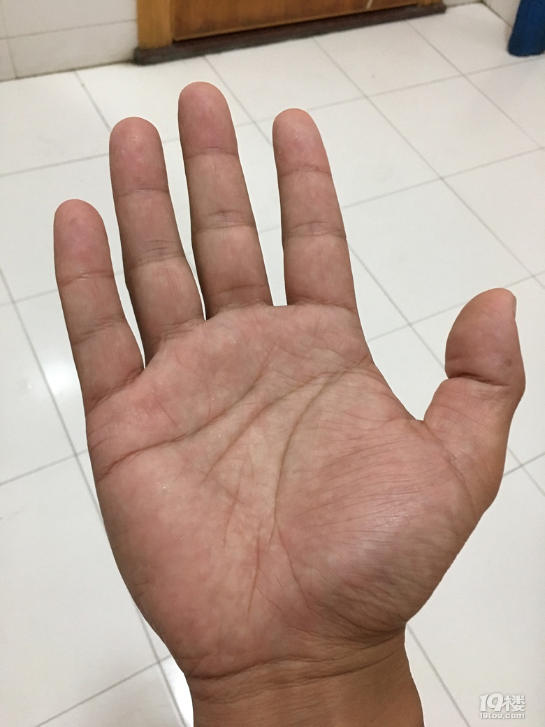 最近手上长茧了!长的位置有点尴尬大家有没