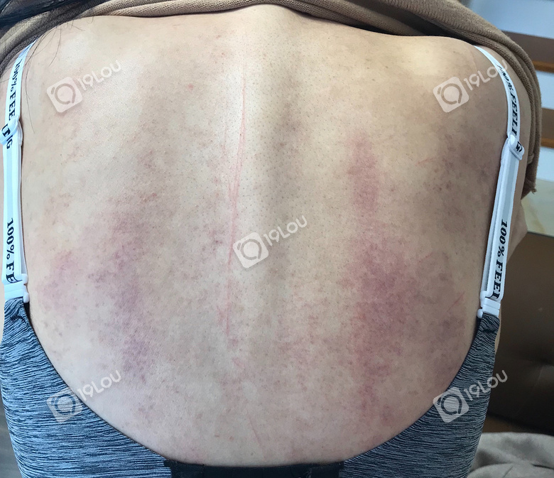 两个90后妹纸做背部护理被划伤商家辱骂诅咒顾客