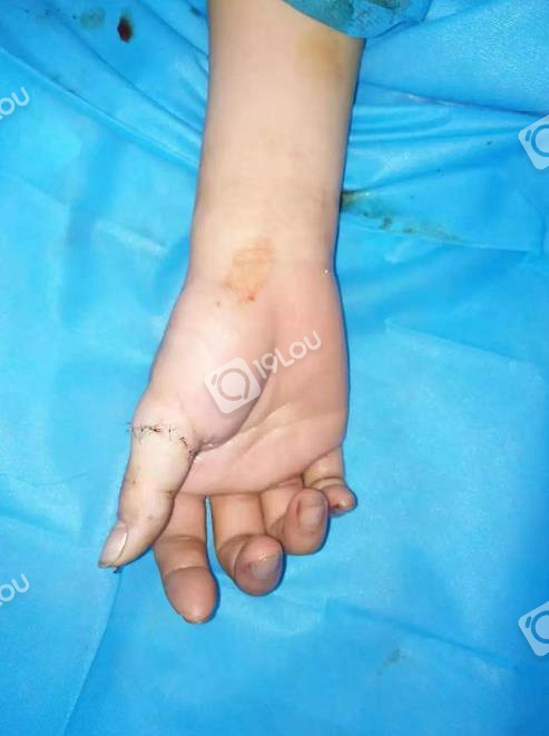 震惊女子被老公残忍剪断手指拿着断指走进嘉兴某医院