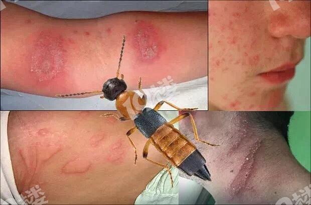 被翅隐虫咬了的我感觉快要截肢了呜呜呜