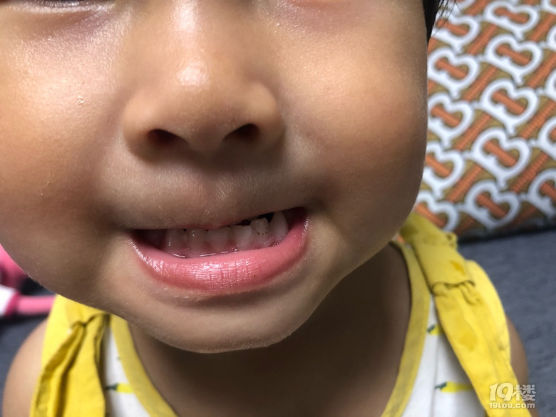 小孩子牙上有黑点点是龋齿吗