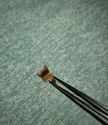 5岁儿子从没有掏过耳屎堵成水泥状一碰疼得哇哇直叫