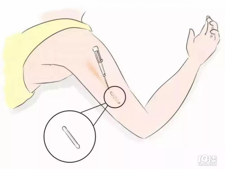 产后避孕你们都是用的什么方法纠结是去安环还是做皮下埋置