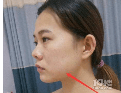 咬肌过大怎么办,5招拯救你的大脸