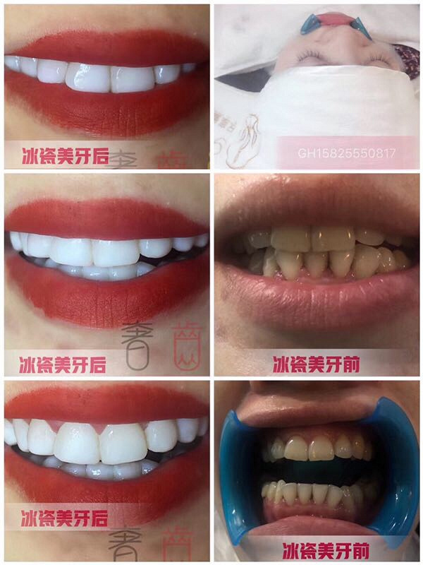奢齿品 冰瓷美牙