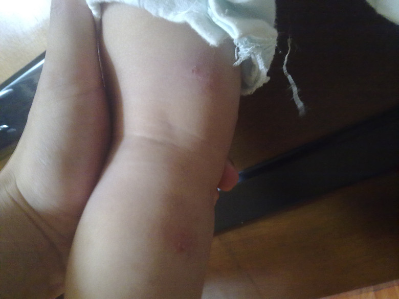 孩子接种疫苗后出现了炎症发烧淋巴结肿大腿上出现肿块