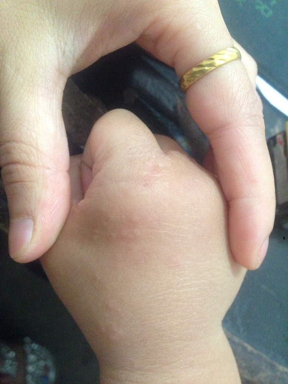 儿子手上长出很多疙瘩不痛不痒的但是就是越发越多