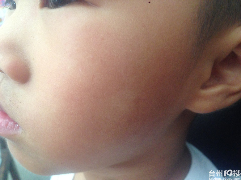 各位妈妈帮忙看看这是纯缺维生素还是儿童白癜风的初期症状