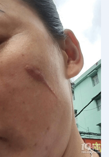 工伤留下来的疤痕修复费用不能报销吗?