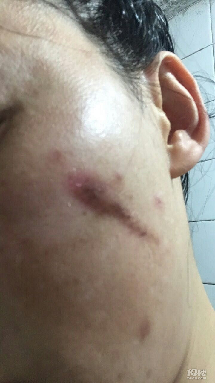 工伤留下来的疤痕修复费用不能报销吗?