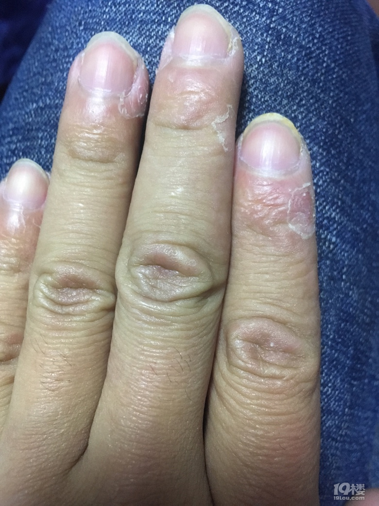 手指脱皮怎么回事