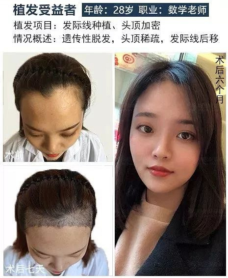 头顶加密种植