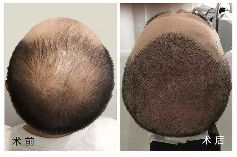 25岁秃顶大学生惊喜变身6小时内长出头发他怎么做到的脱