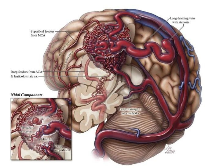 脑中的不定时炸弹——脑动静脉畸形