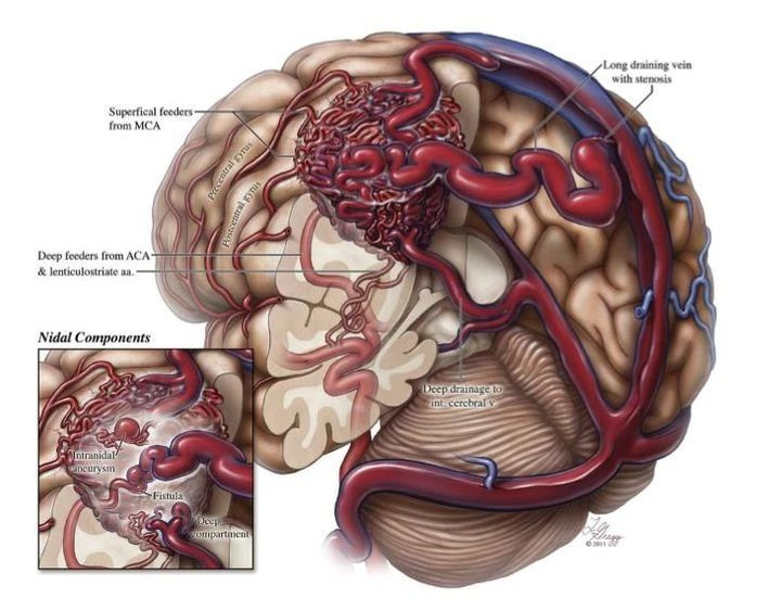 脑中的不定时炸弹脑动静脉畸形