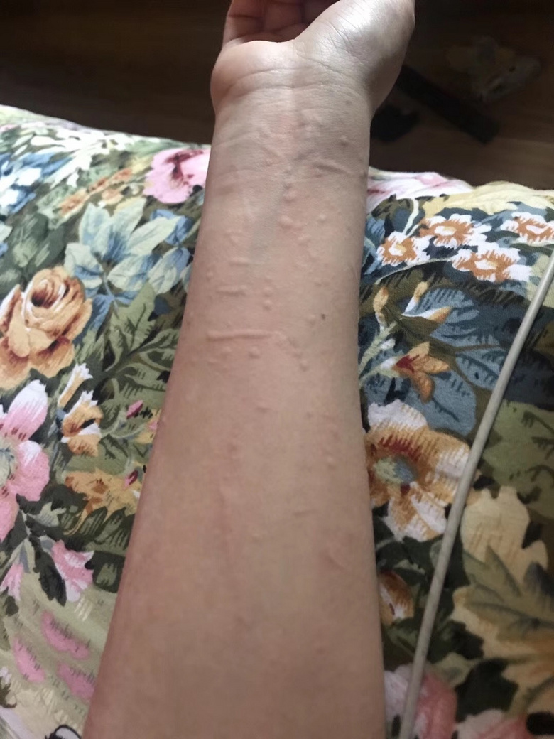 育儿说一受冷就起荨麻疹吃菜叶危及生命过敏体质太难了