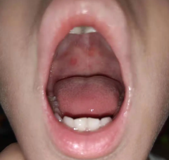 小孩子喉咙长疱疹图片图片